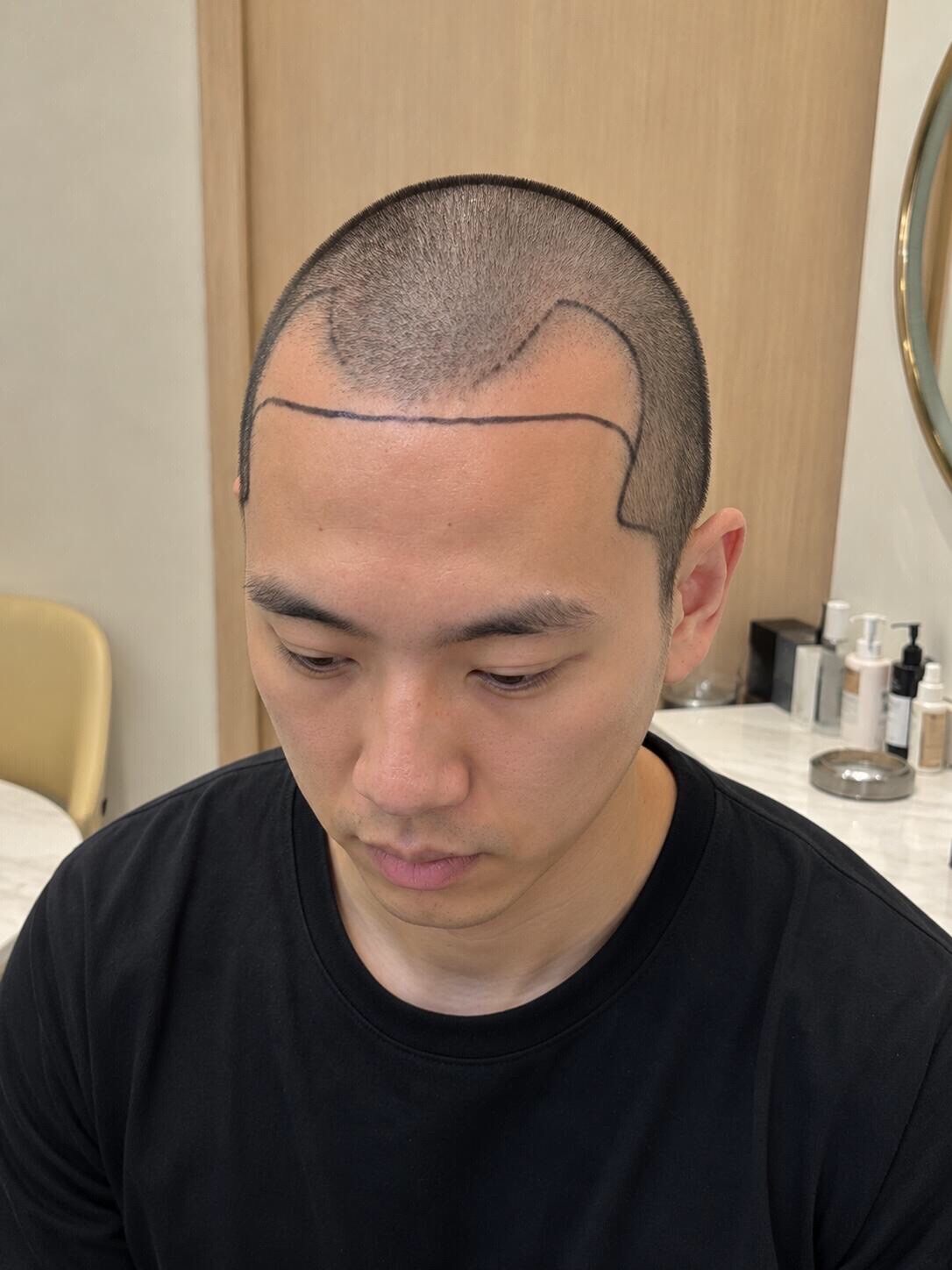 @HAIR TRANSPLANT WANG🇨🇳