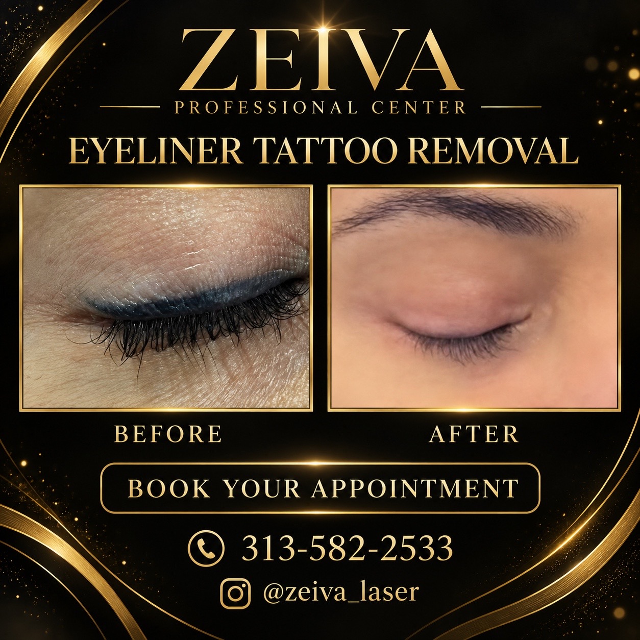 @Zeiva laser /Dearborn MI