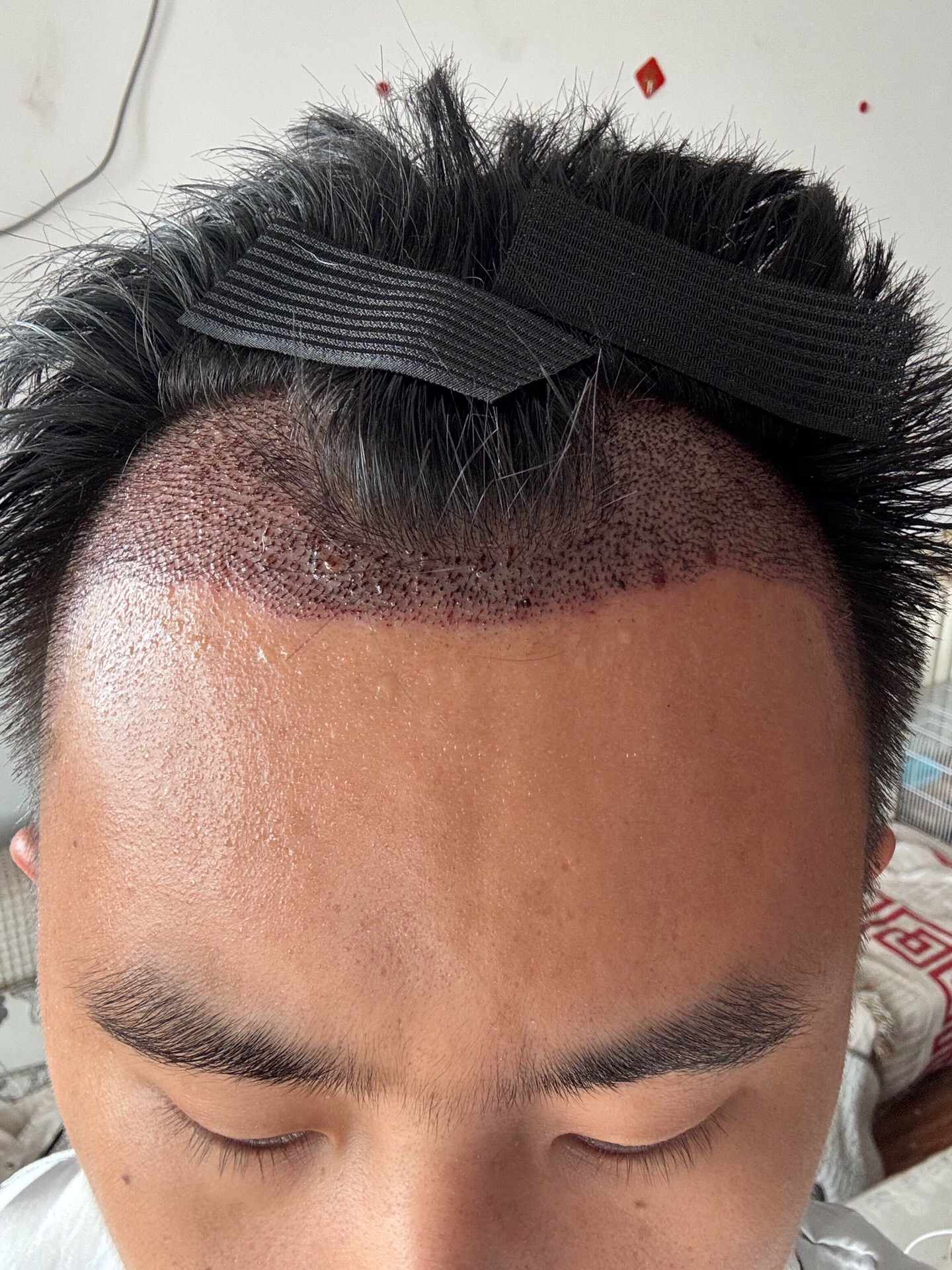 @HAIR TRANSPLANT WANG🇨🇳