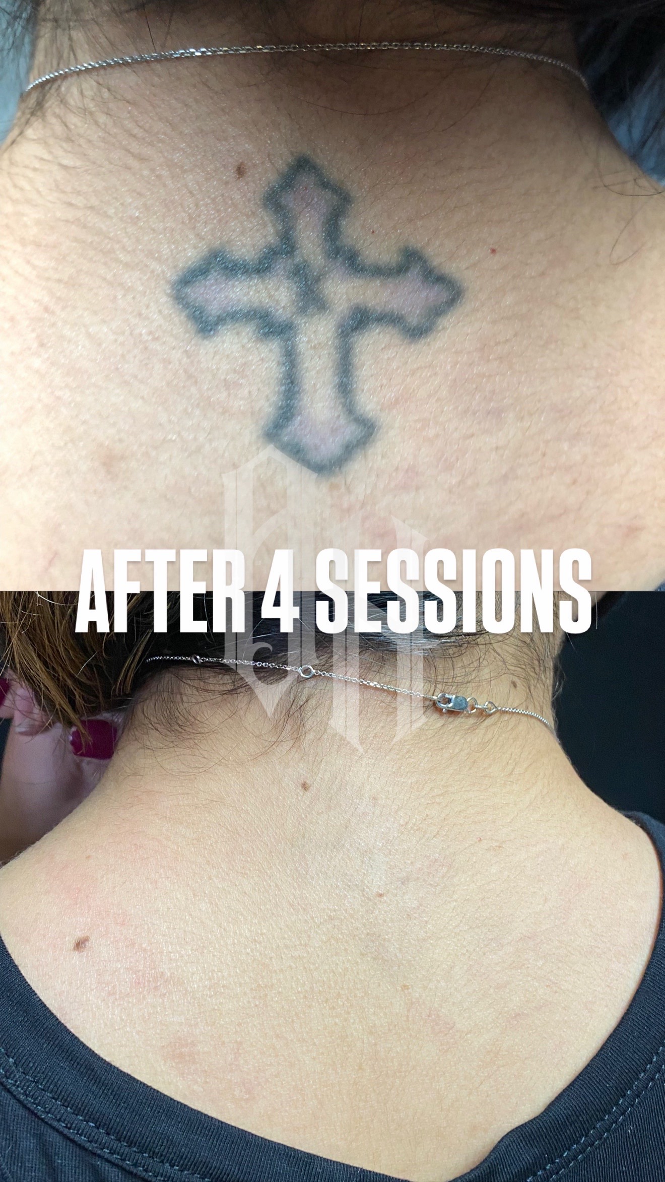@@BHLASERTATTOOREMOVAL