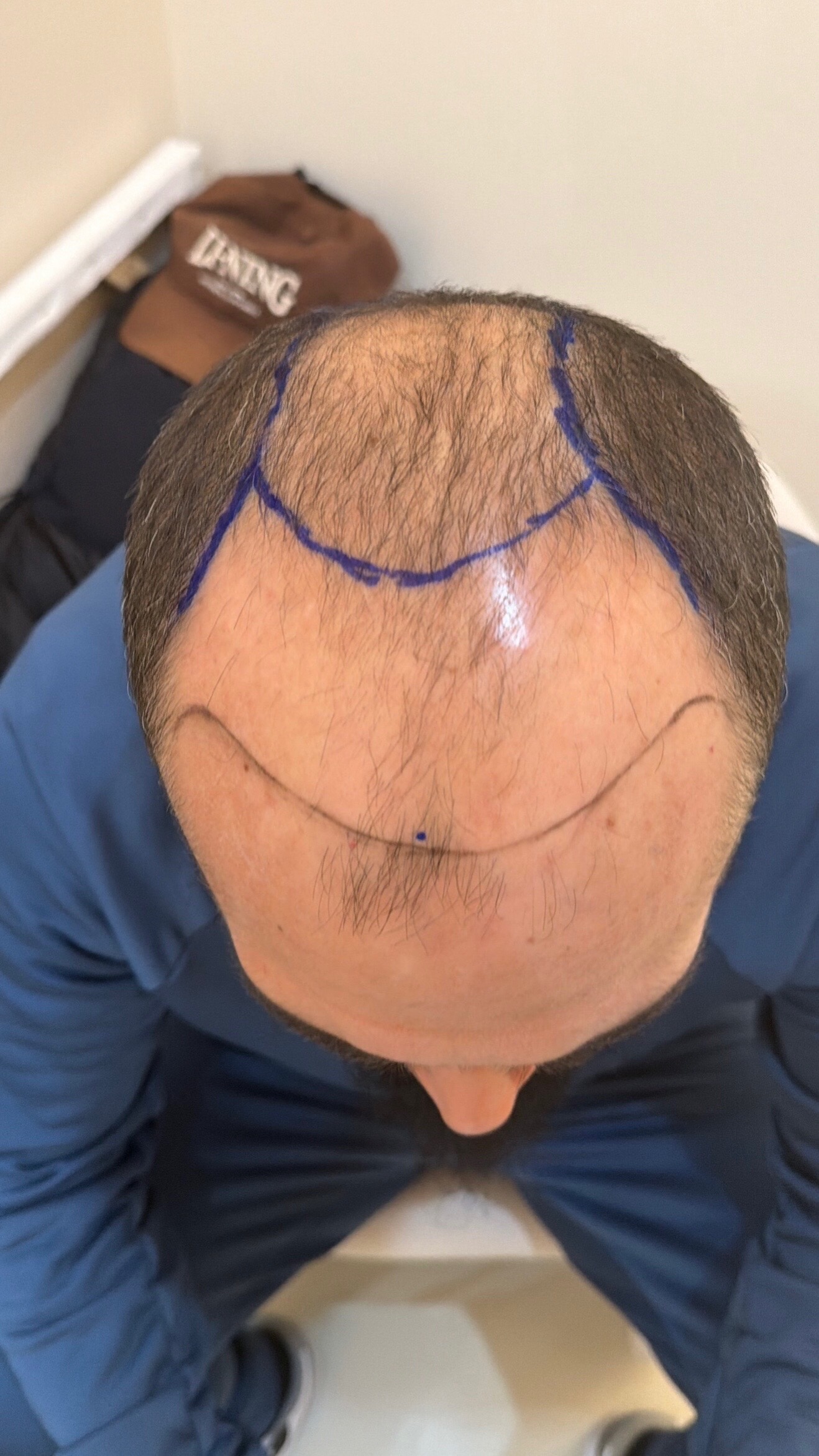 @HAIR TRANSPLANT WANG🇨🇳