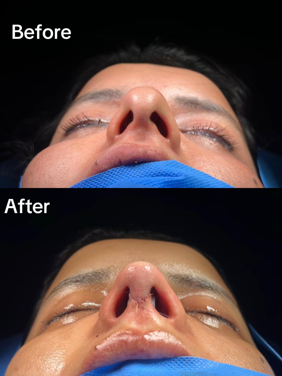 @Rhinoplastyhub clinic222