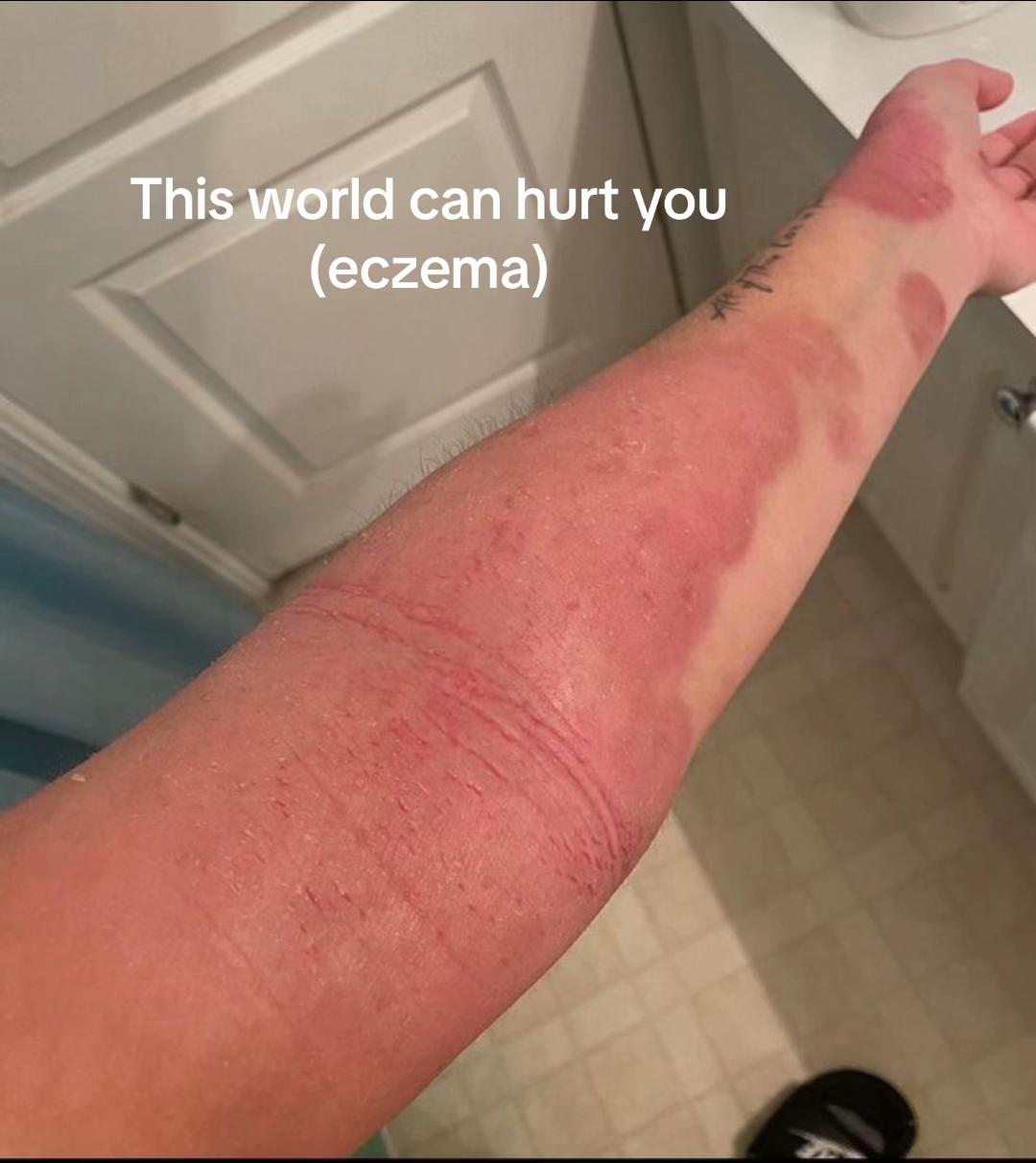 @Eczema Diaries USA & UK