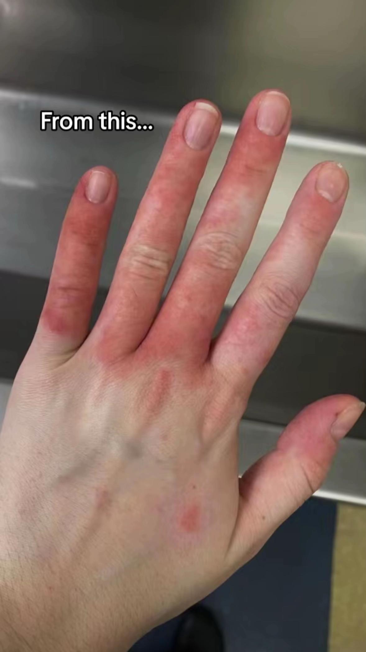 @Eczema Diaries USA & UK