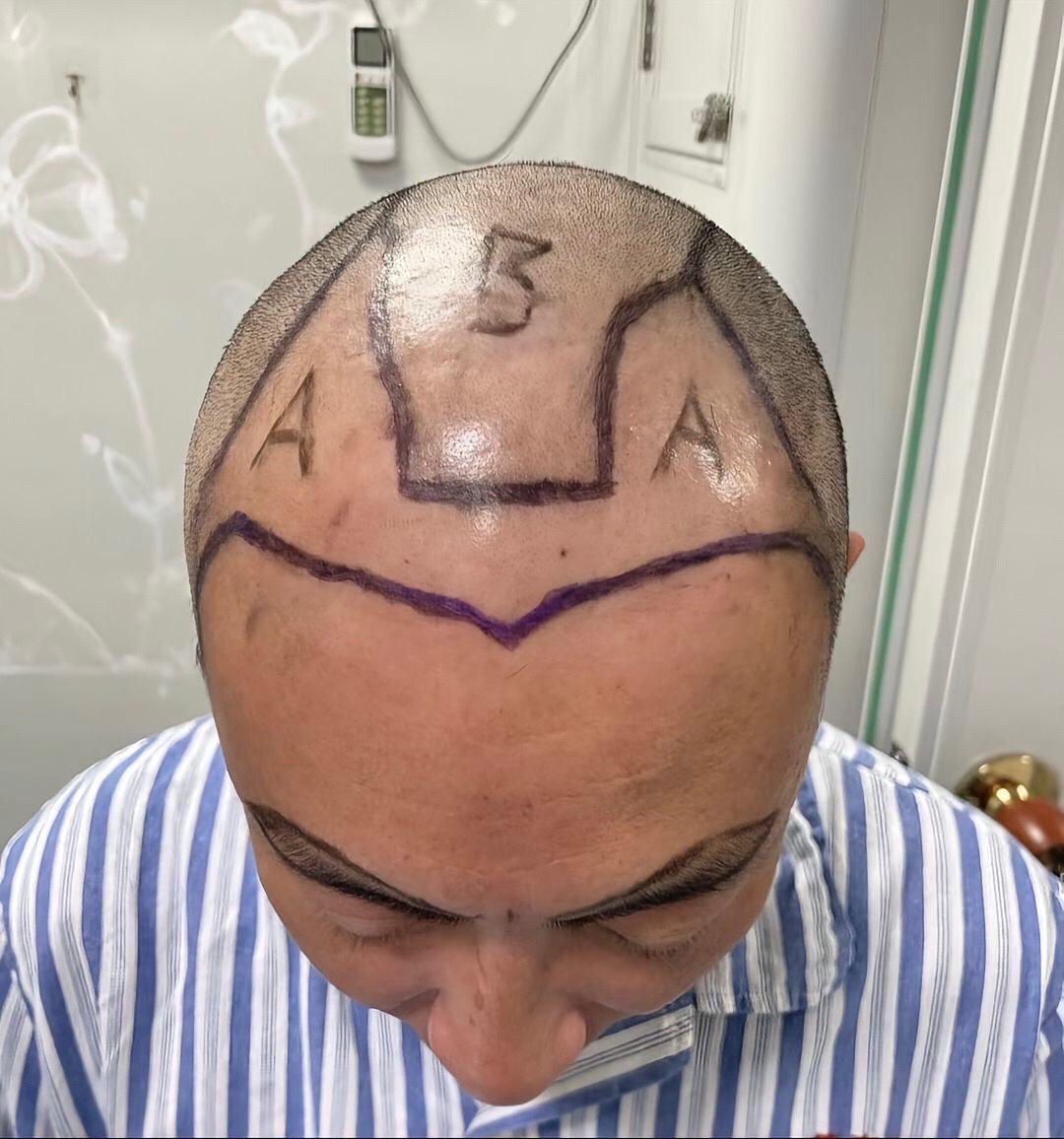 @HAIR TRANSPLANT WANG🇨🇳