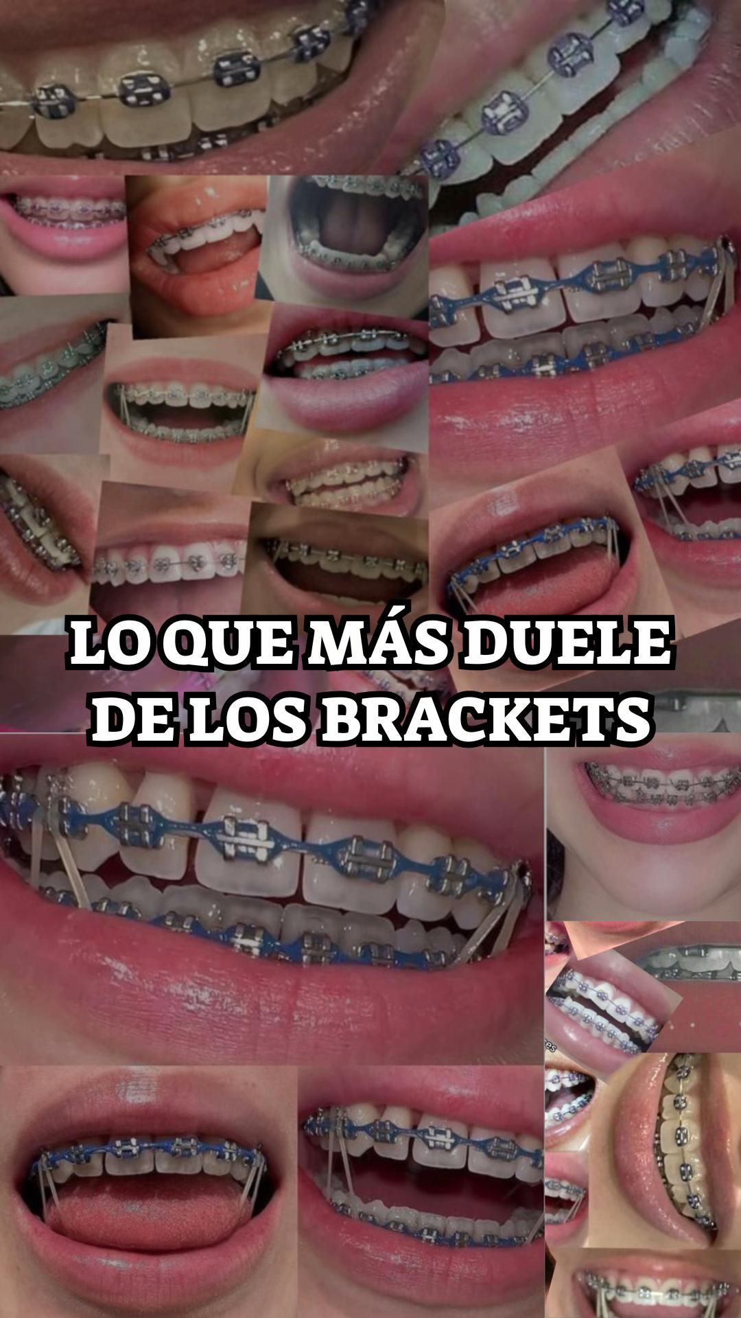 @Brackets y Alineadores