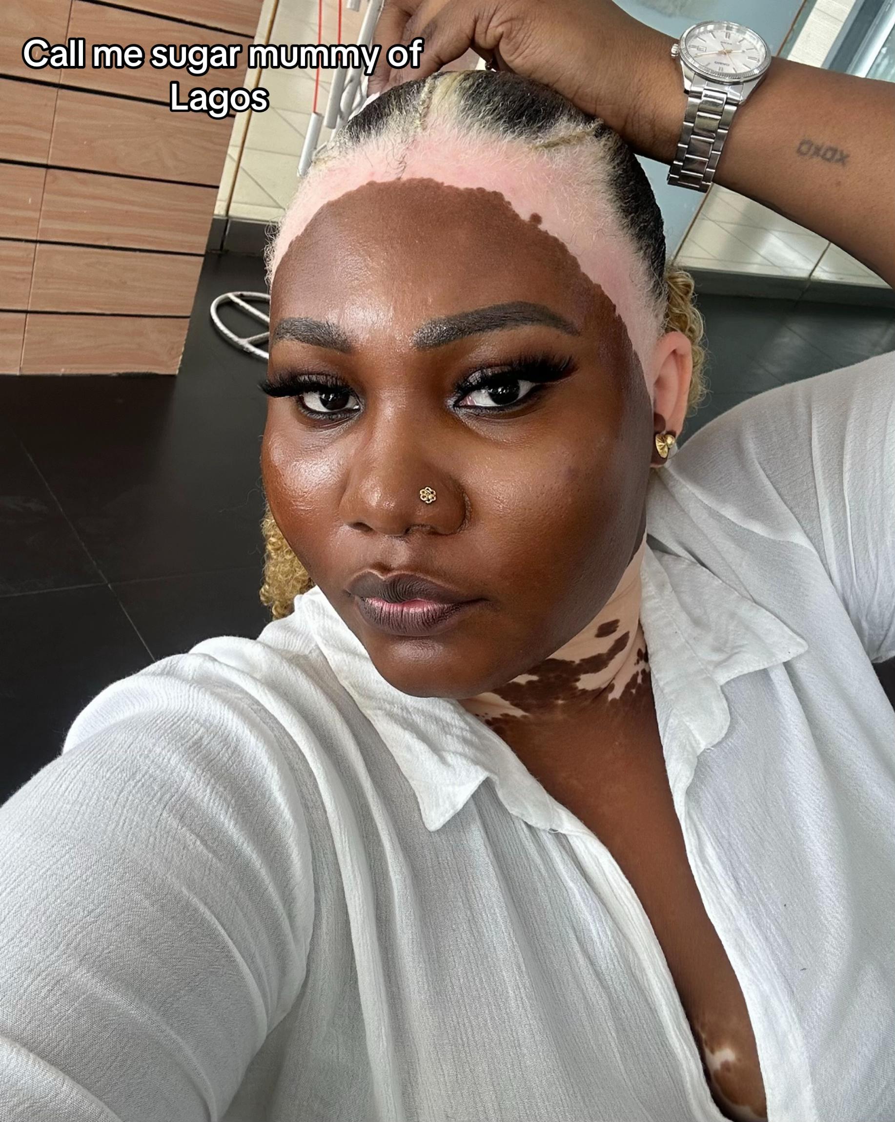 @Thevitiligogirl