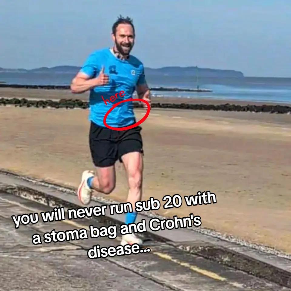 @Running Stoma