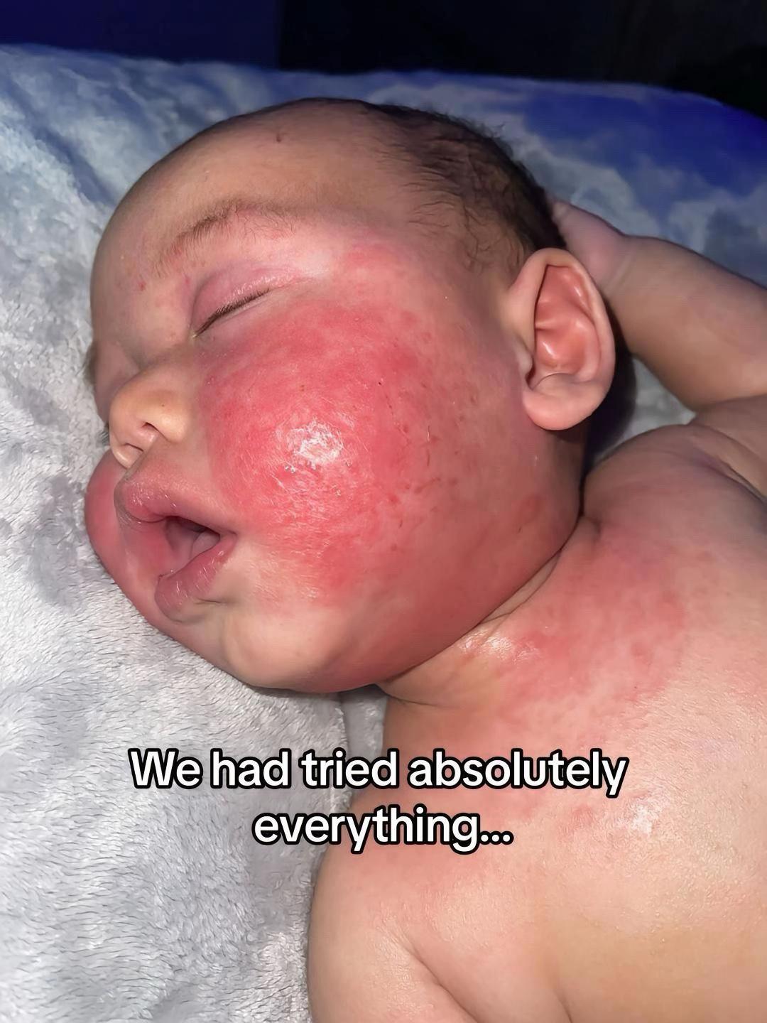 @Eczema Diaries USA & UK