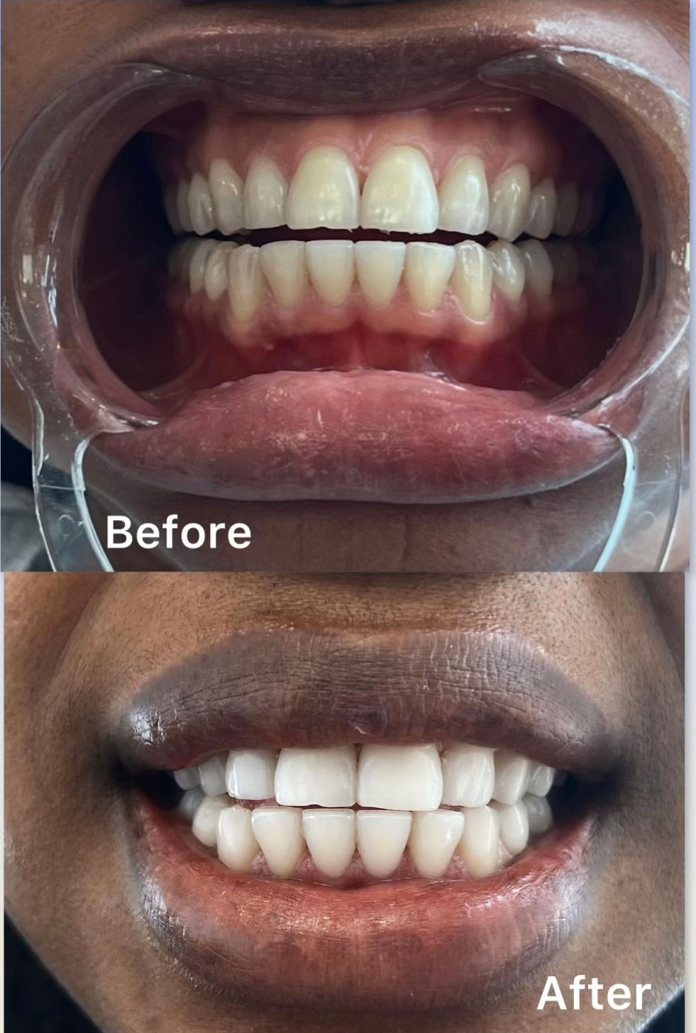 @Whiten Lighten TAC
