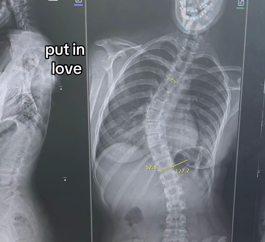 @Scoliosis awareness