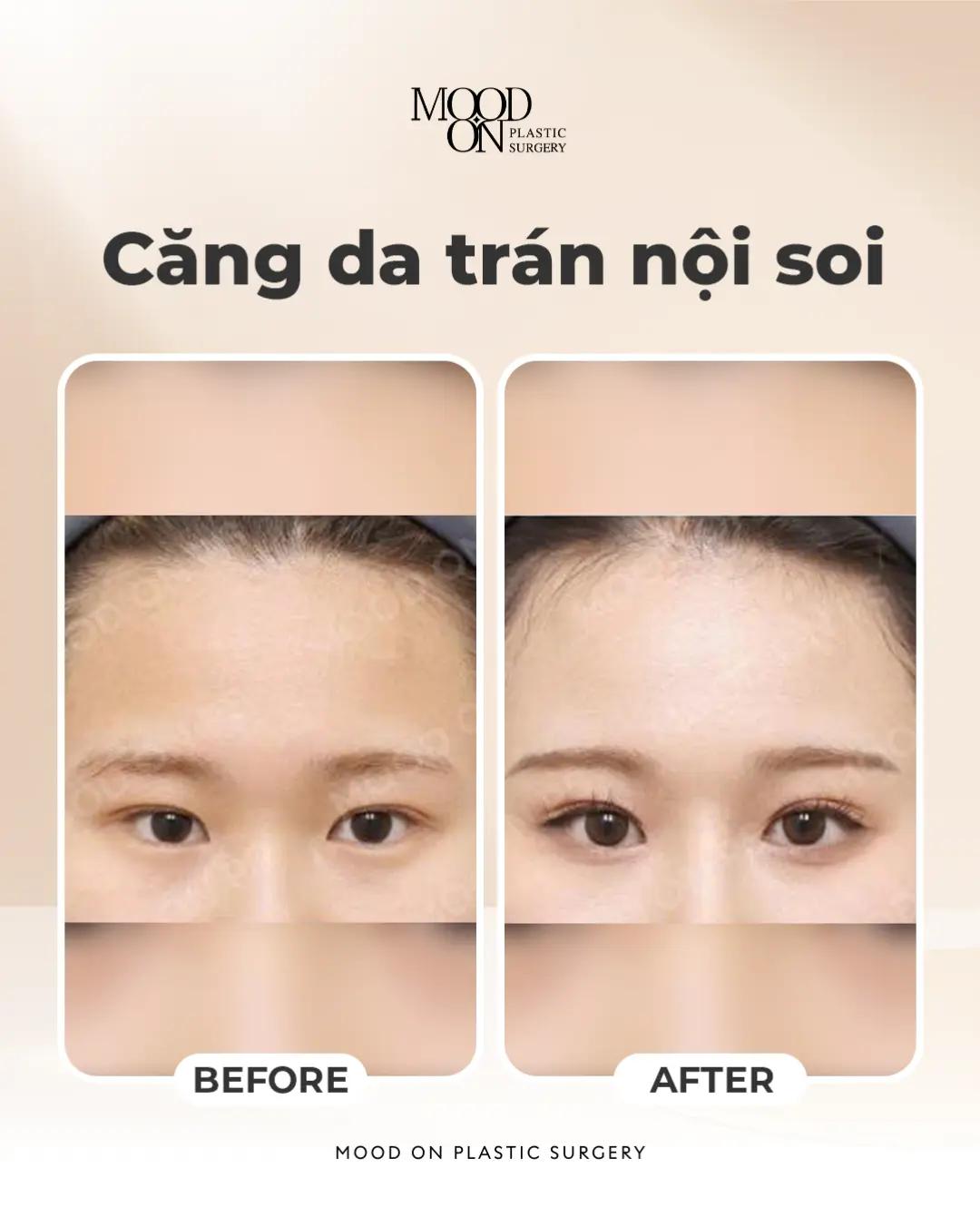 @Bệnh viện thẩm mỹ Mood On