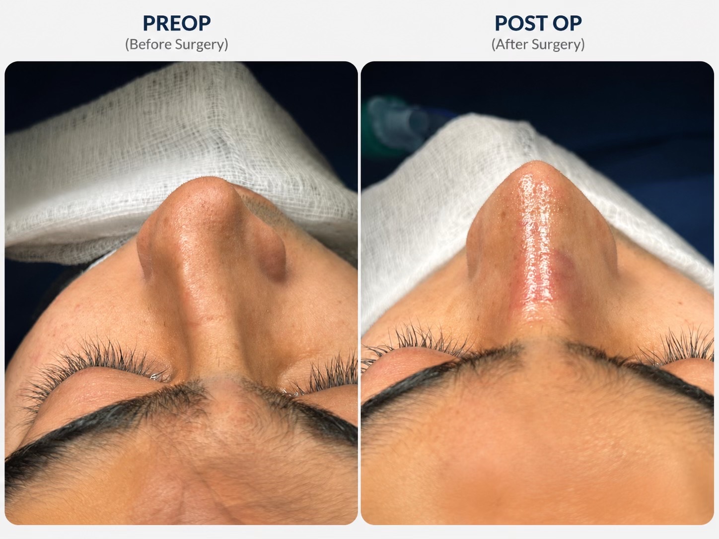 @Rhinoplastyhub clinic222