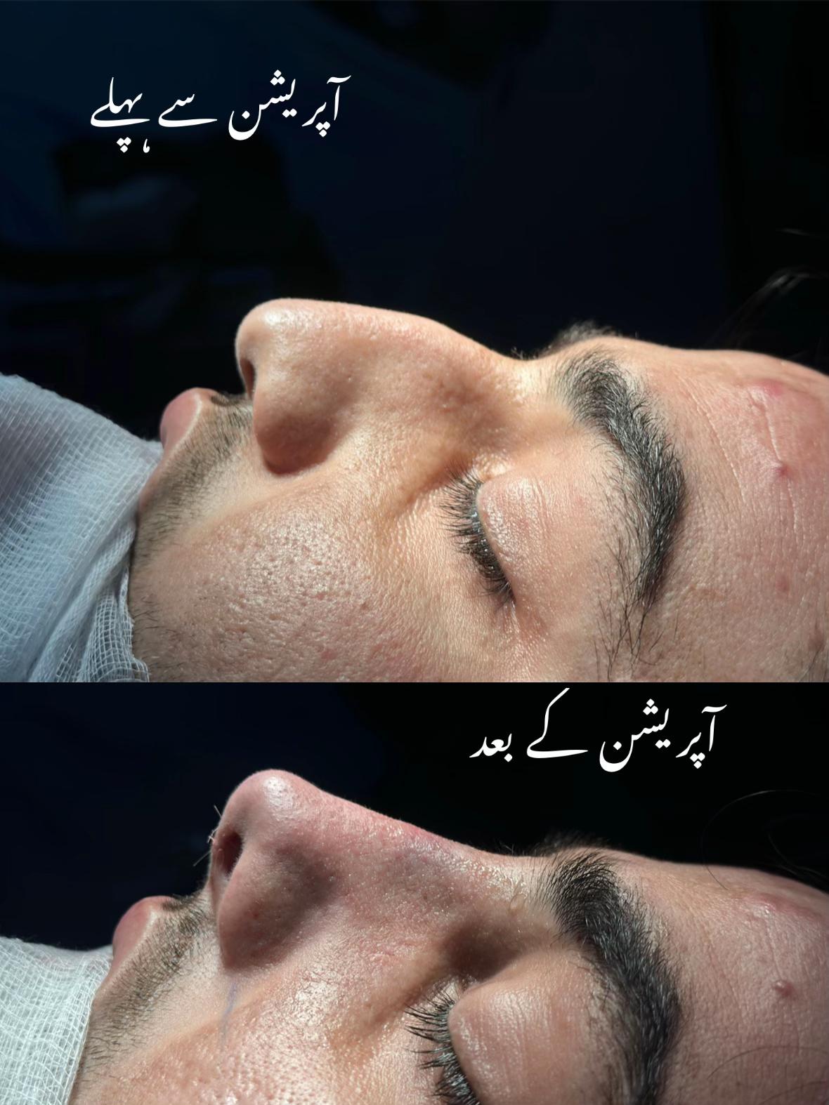@Rhinoplastyhub clinic222