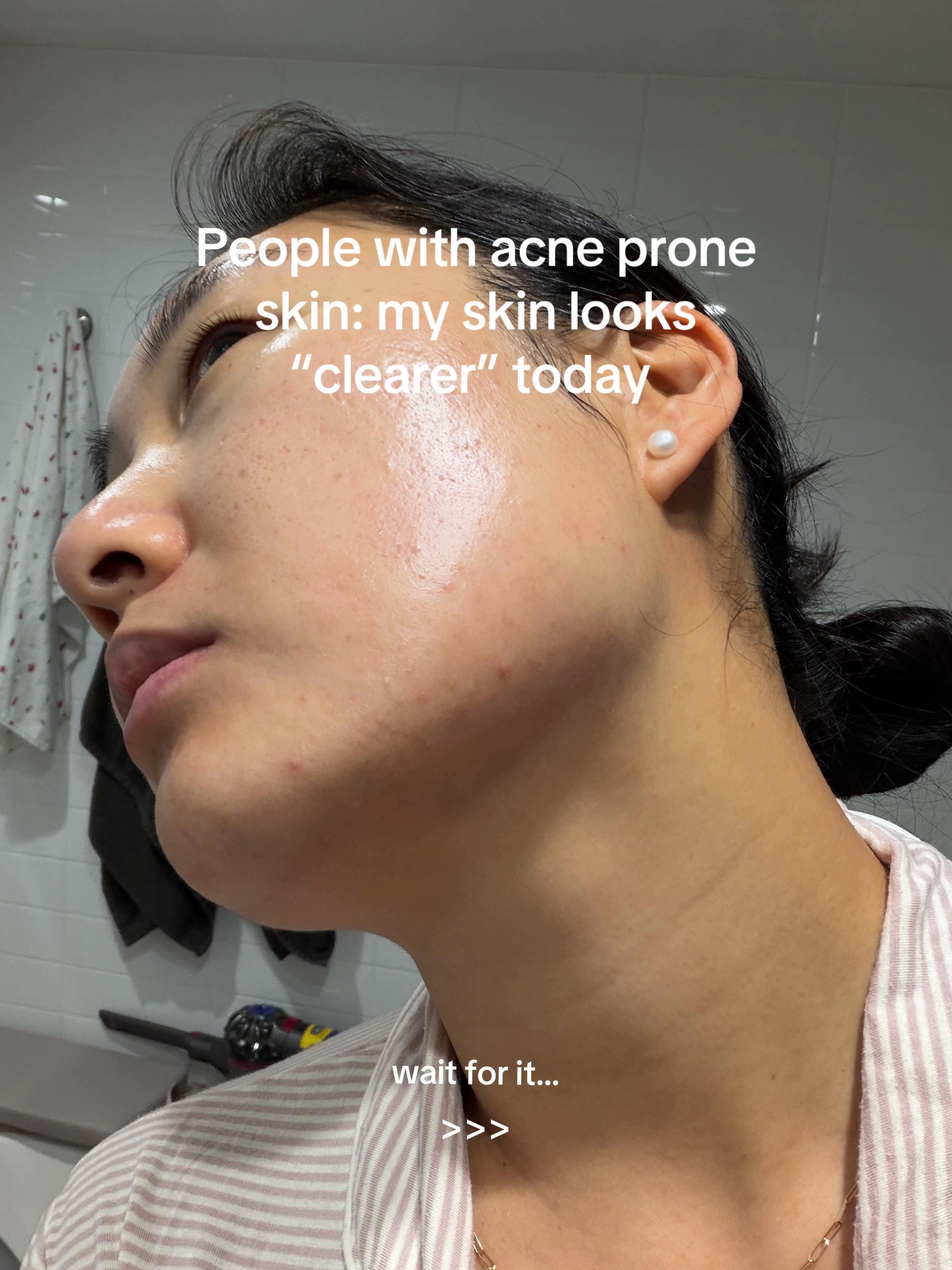 @Lisa | acne → clear skin