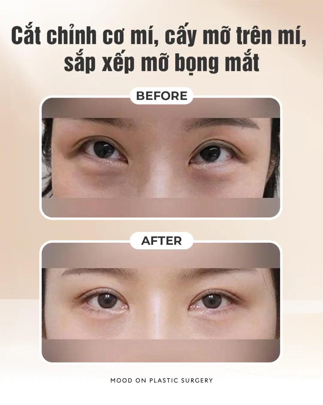 @Bệnh viện thẩm mỹ Mood On