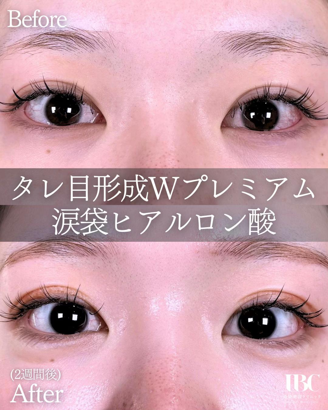 @高倉光平【タレ目形成×目尻切開】