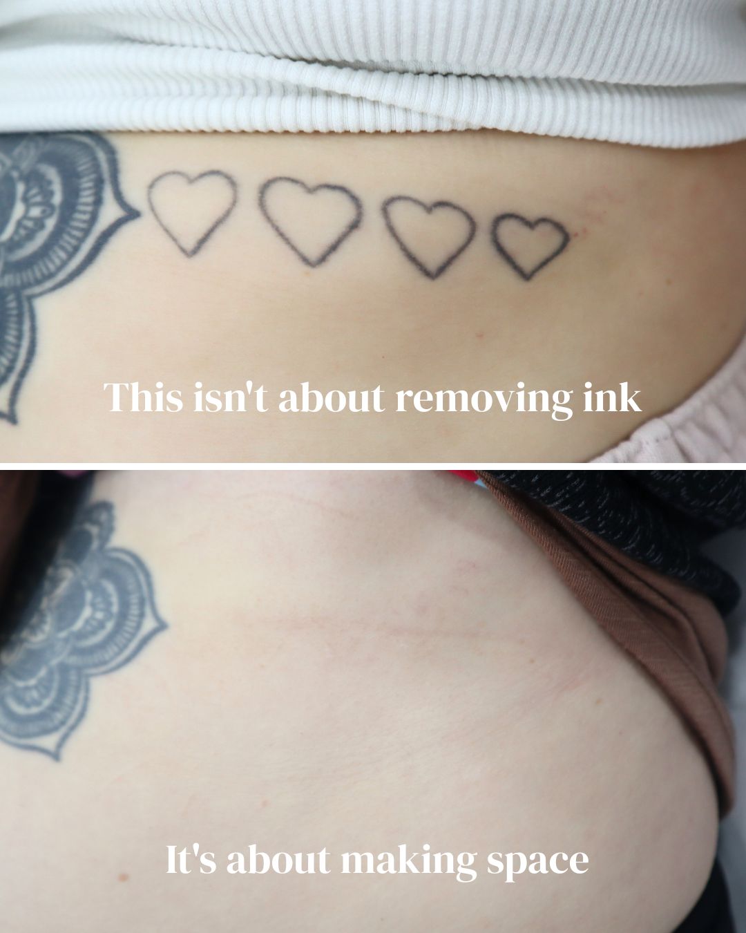 @Jamie T| Tattoo Removal Expert