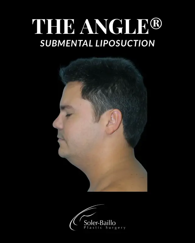 @Soler Baillo Plastic Surgery