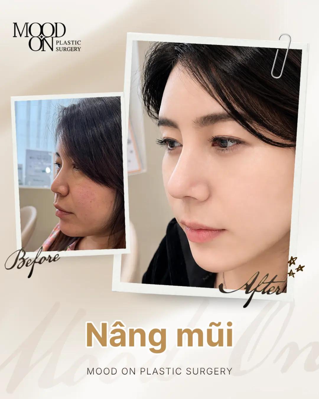 @Bệnh viện thẩm mỹ Mood On
