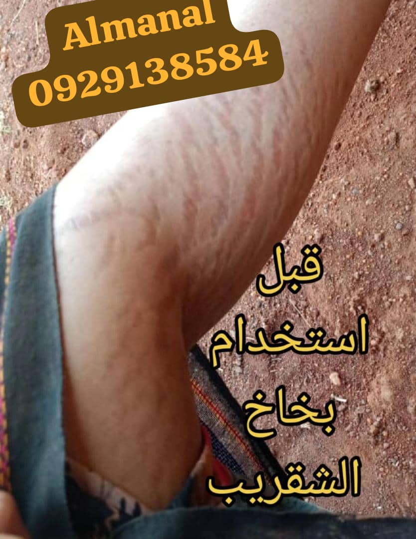 @drmanal " لعلاج التشققات "