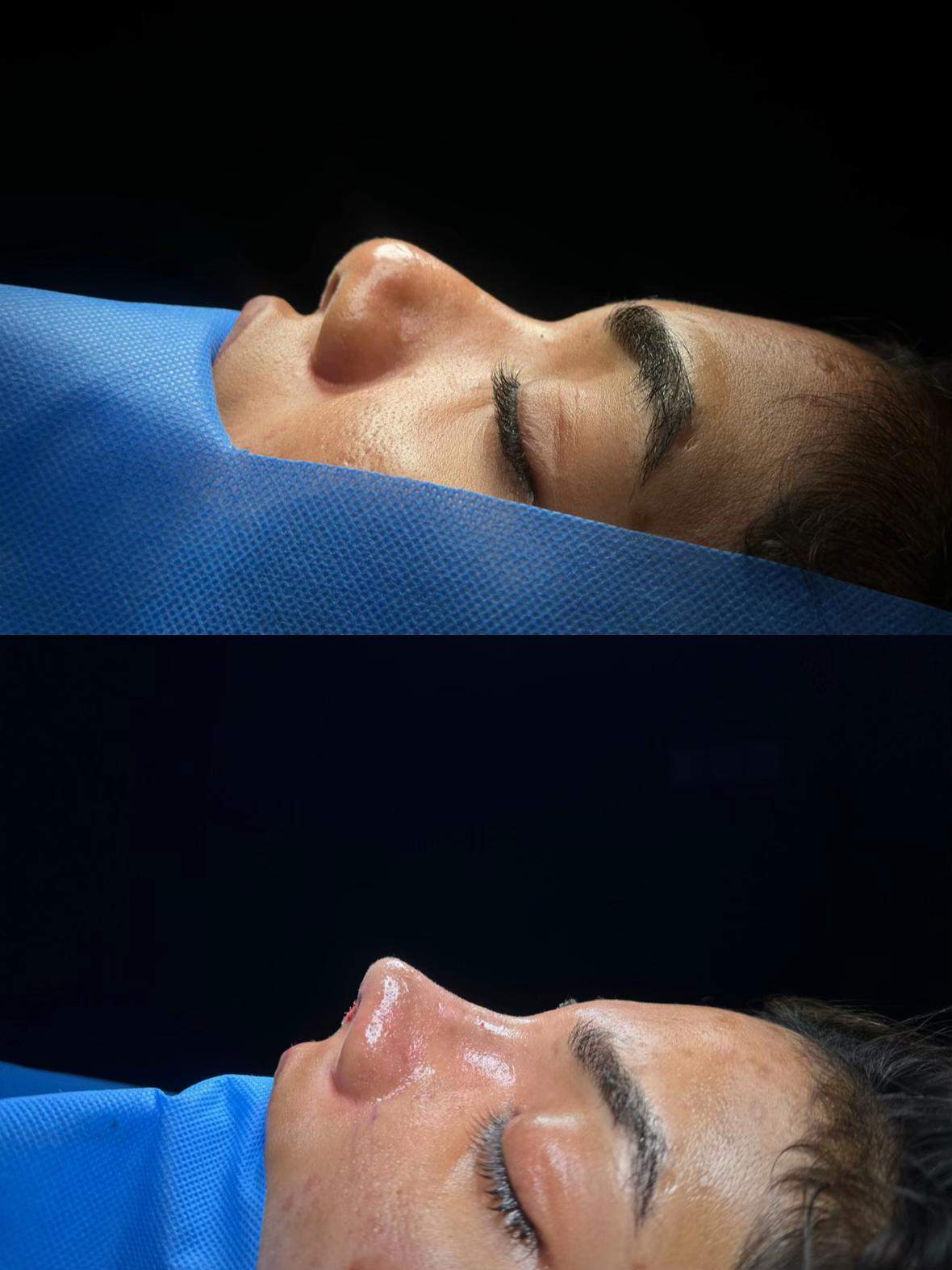 @Rhinoplastyhub clinic222
