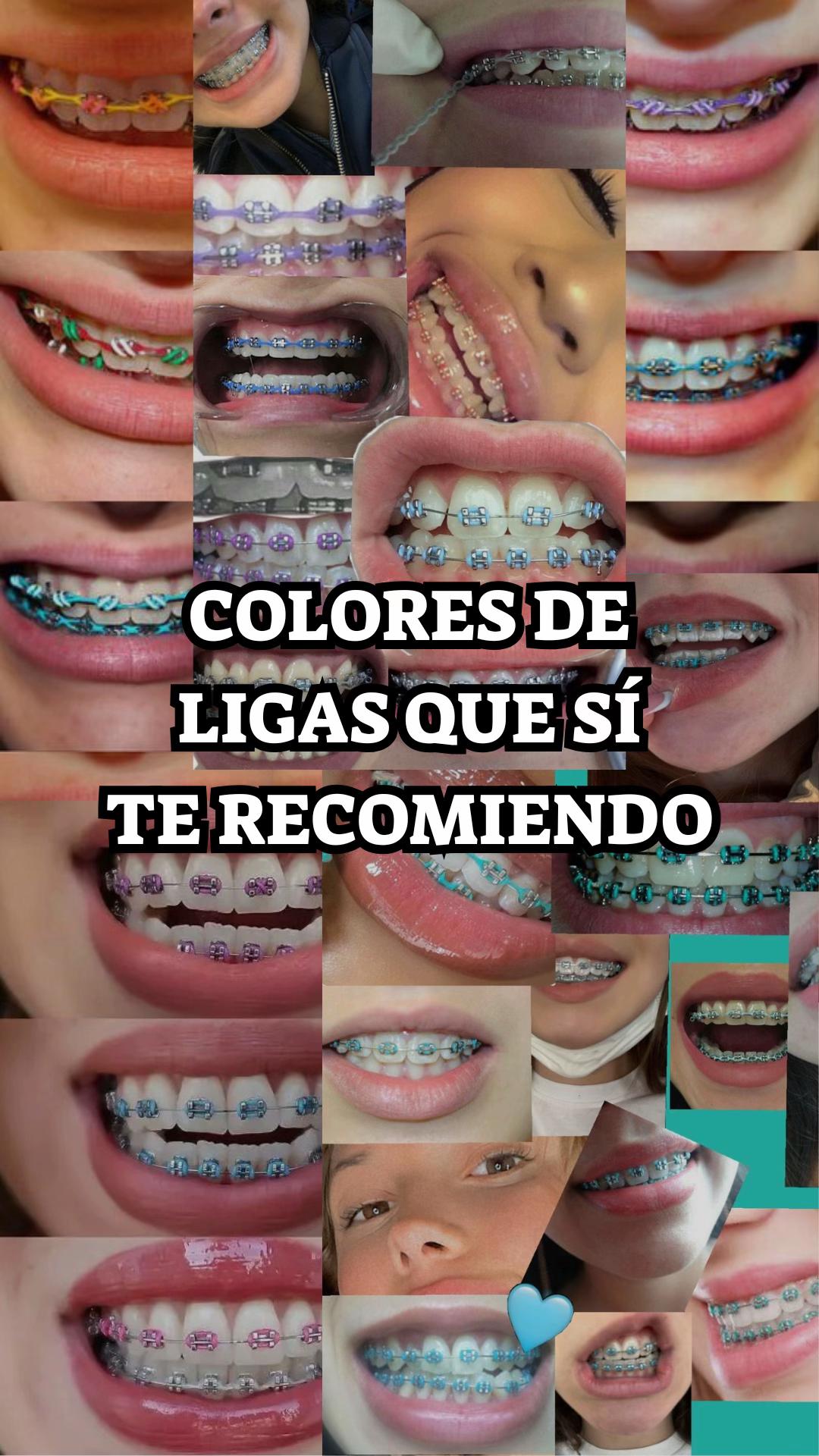 @Brackets y Alineadores
