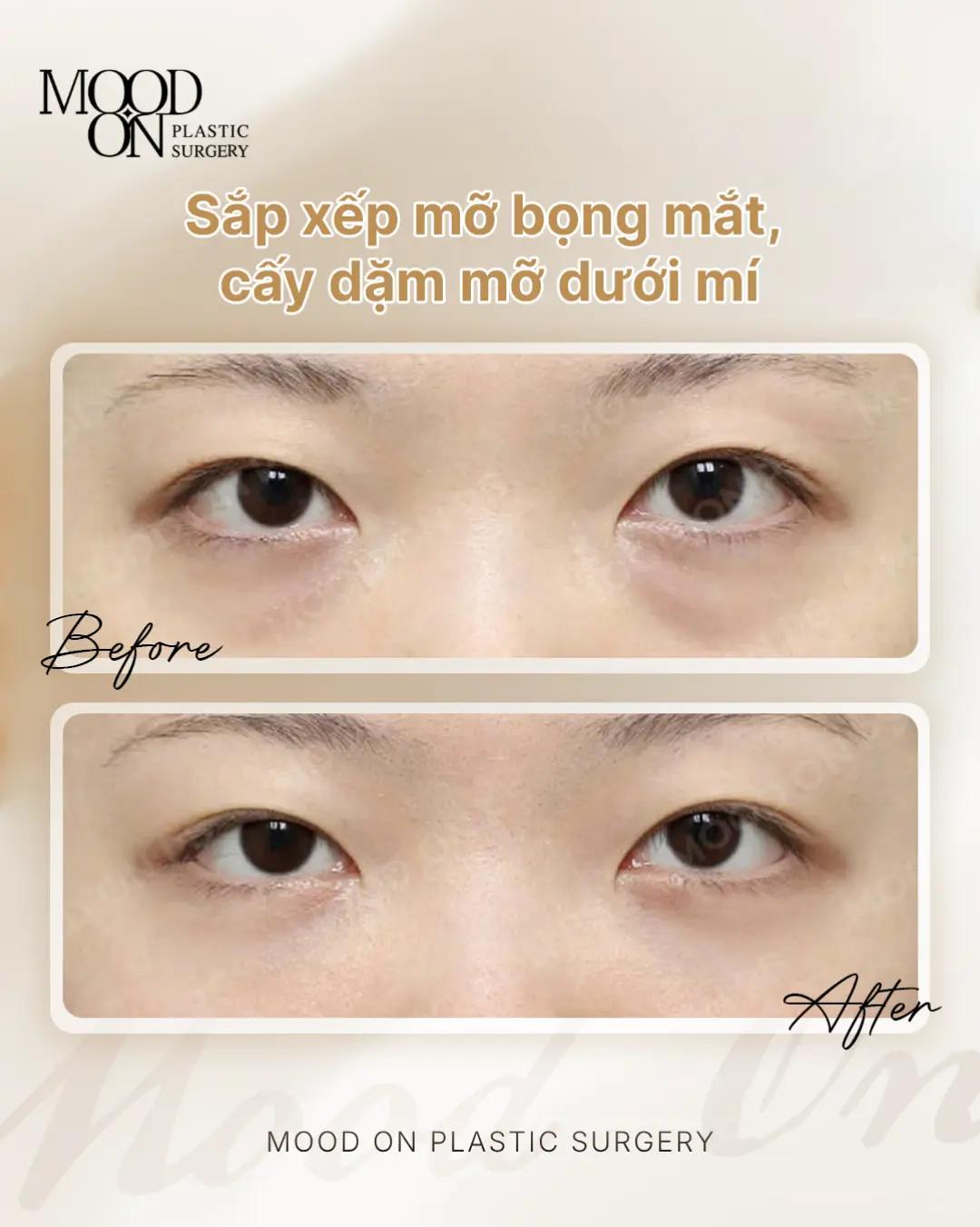 @Bệnh viện thẩm mỹ Mood On