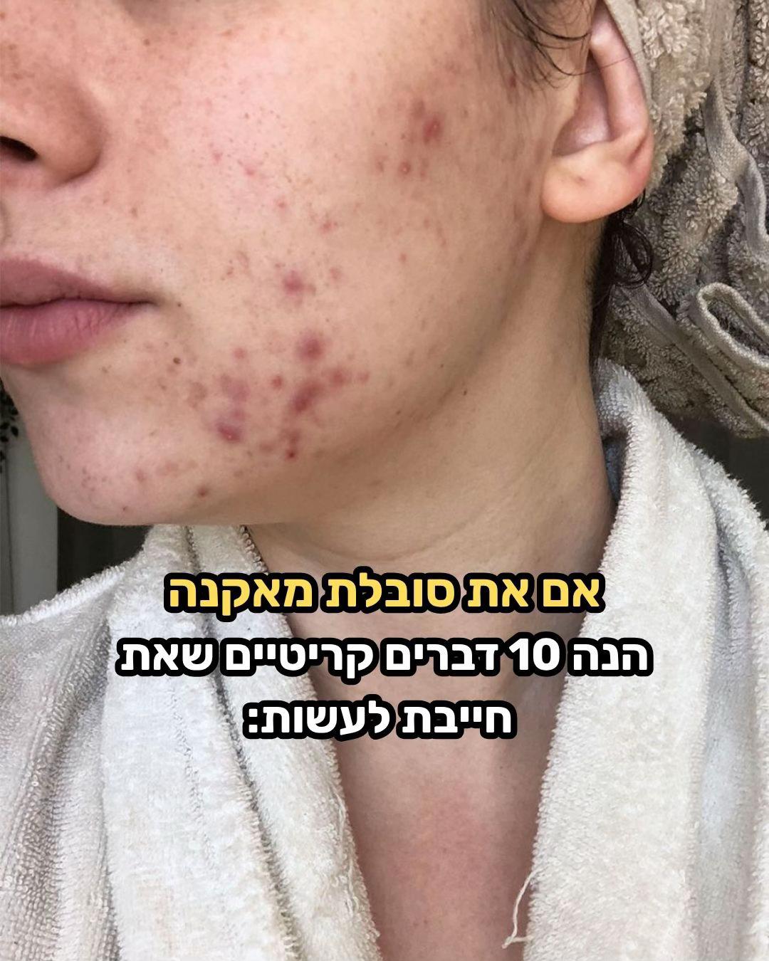 @תמר זריבץ - אקנה ופוסט אקנה