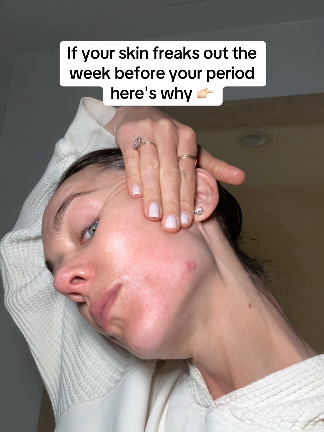 @Celeste | RN acne expert