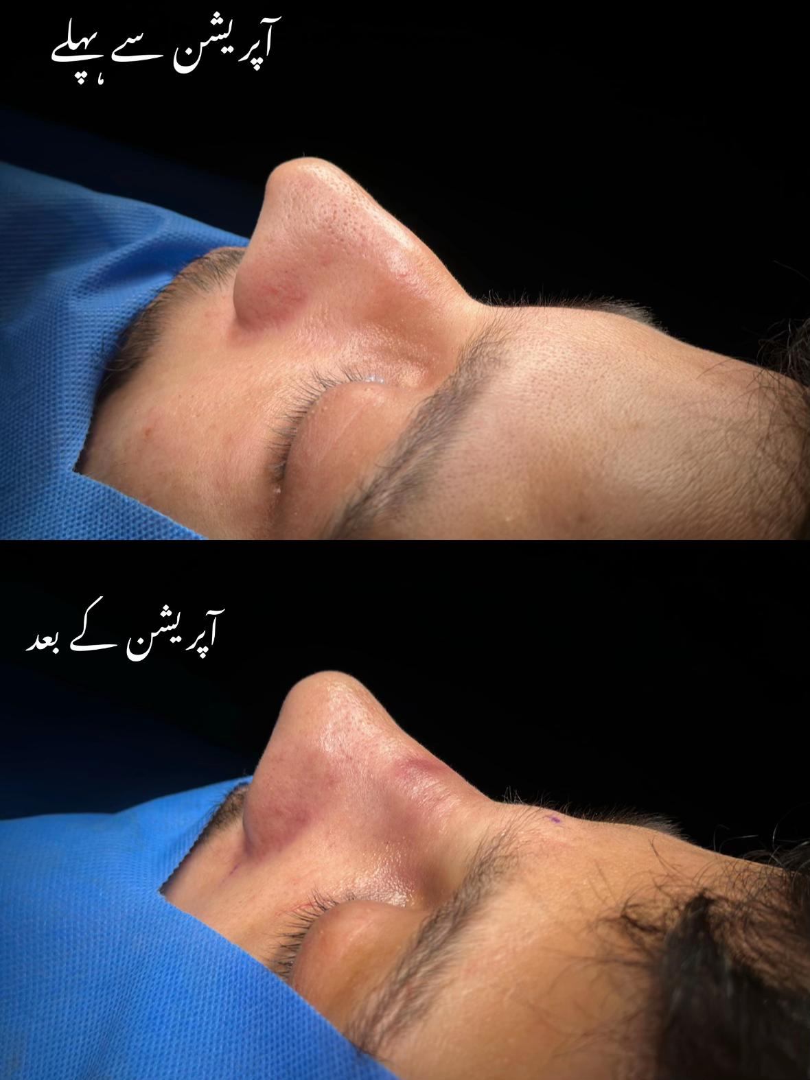 @Rhinoplastyhub clinic222
