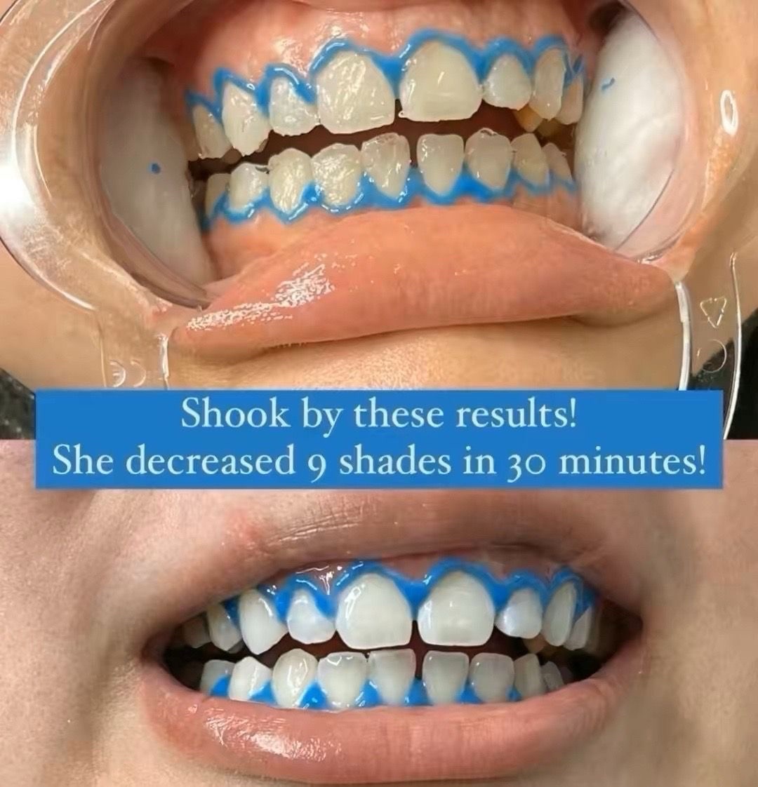 @Diandra | Teeth Whitening Tech