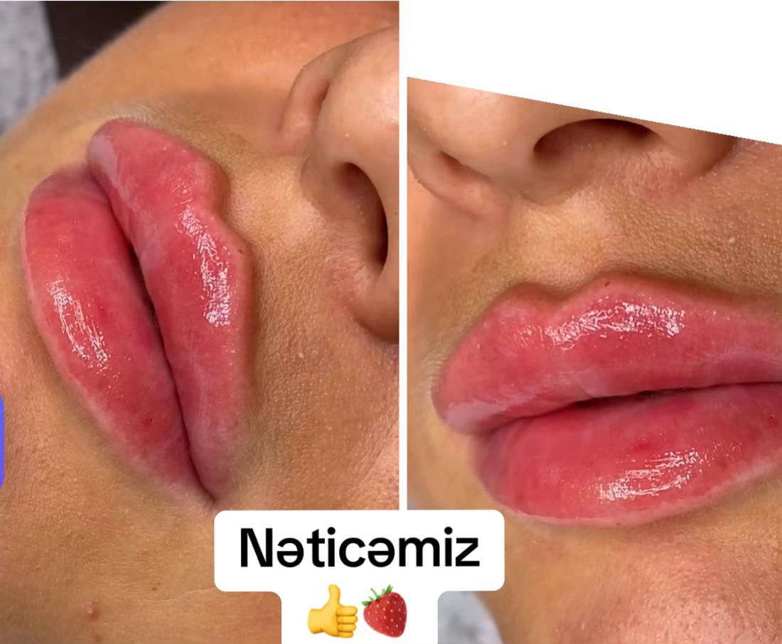 @Xankəndi.Şuşa.💉Kosmetoloq💉
