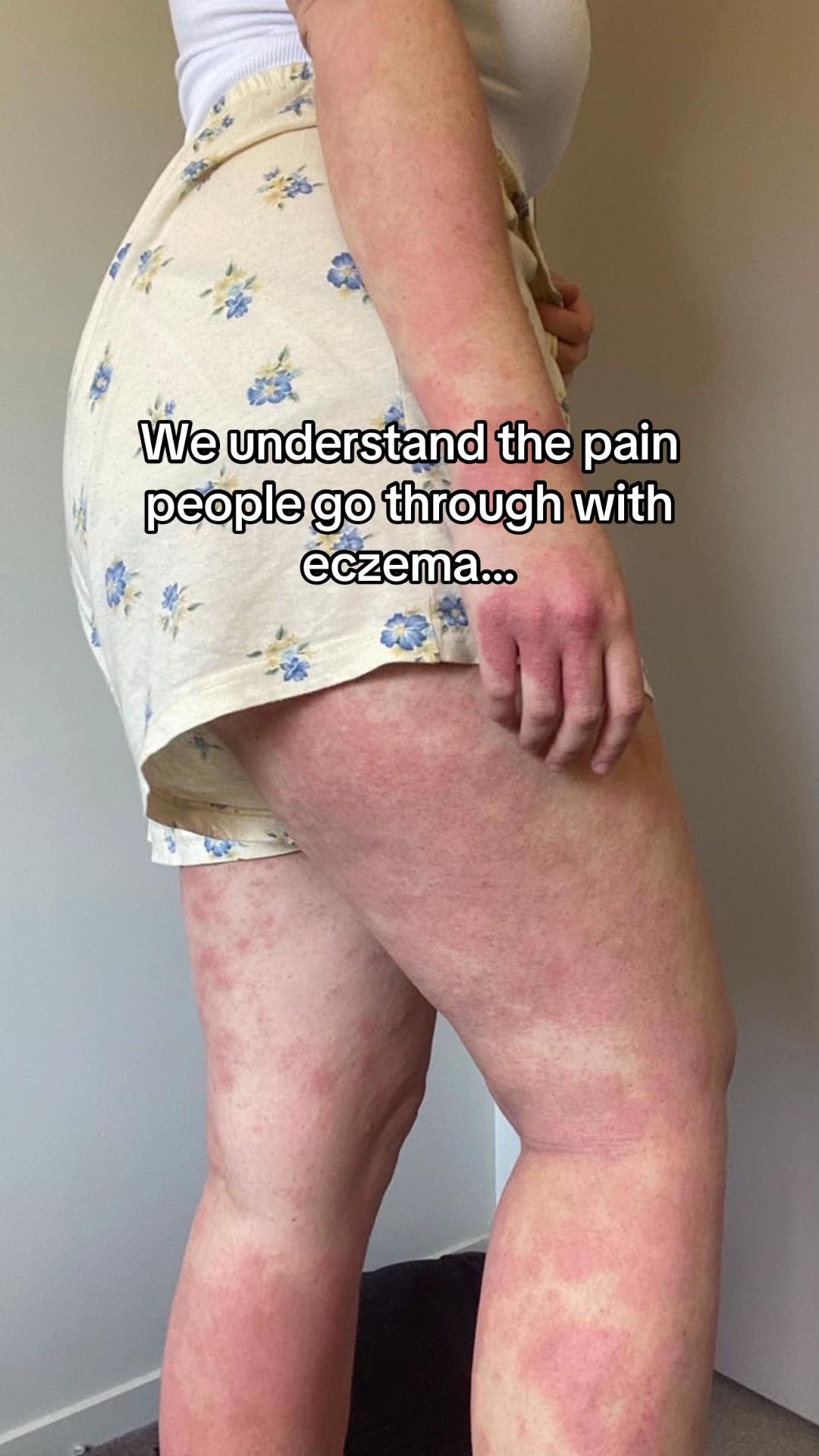 @Eczema Diaries USA & UK