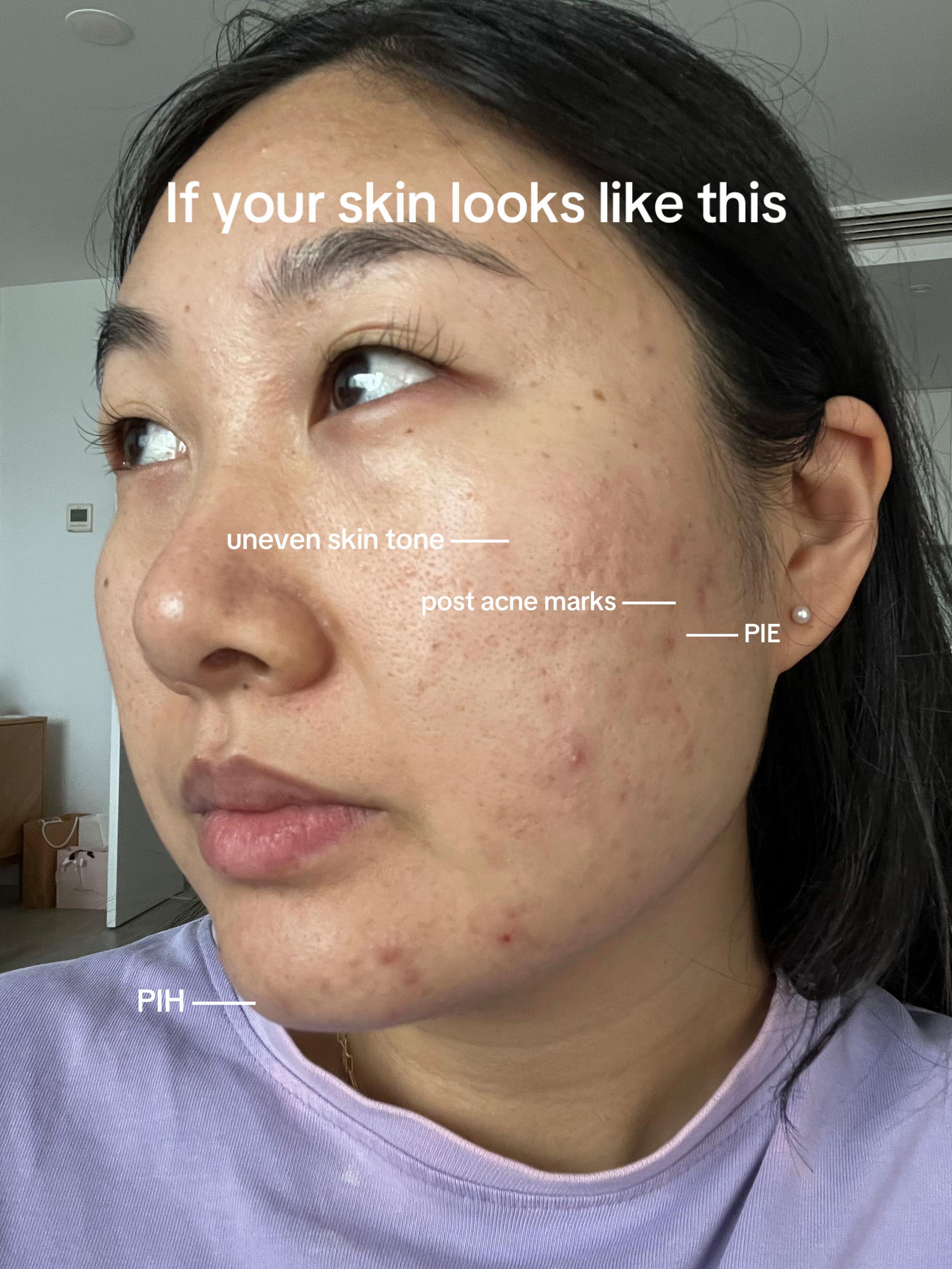 @Lisa | acne &rarr; clear skin
