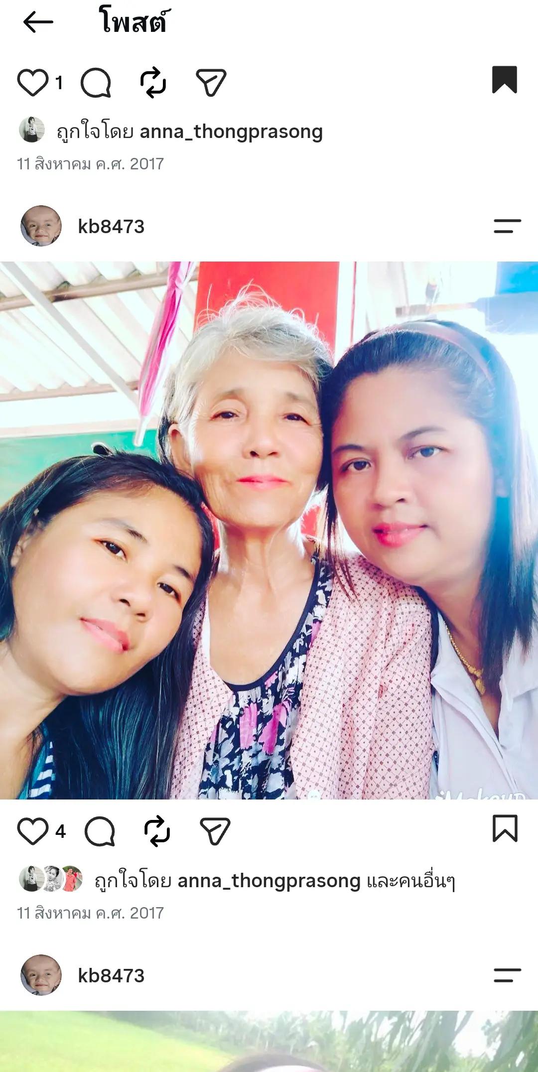 @บู้บี้เด็กหัวโตมีน้ำในโพรงสมอง