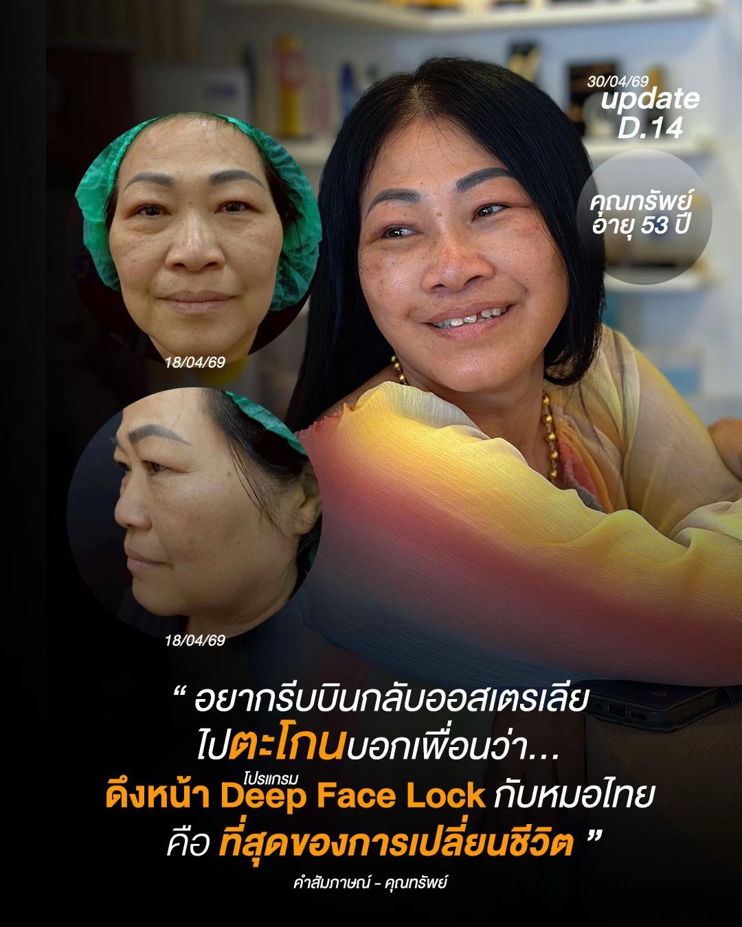 @ดึงหน้า ud clinic