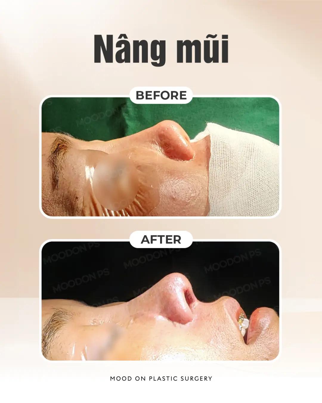 @Bệnh viện thẩm mỹ Mood On