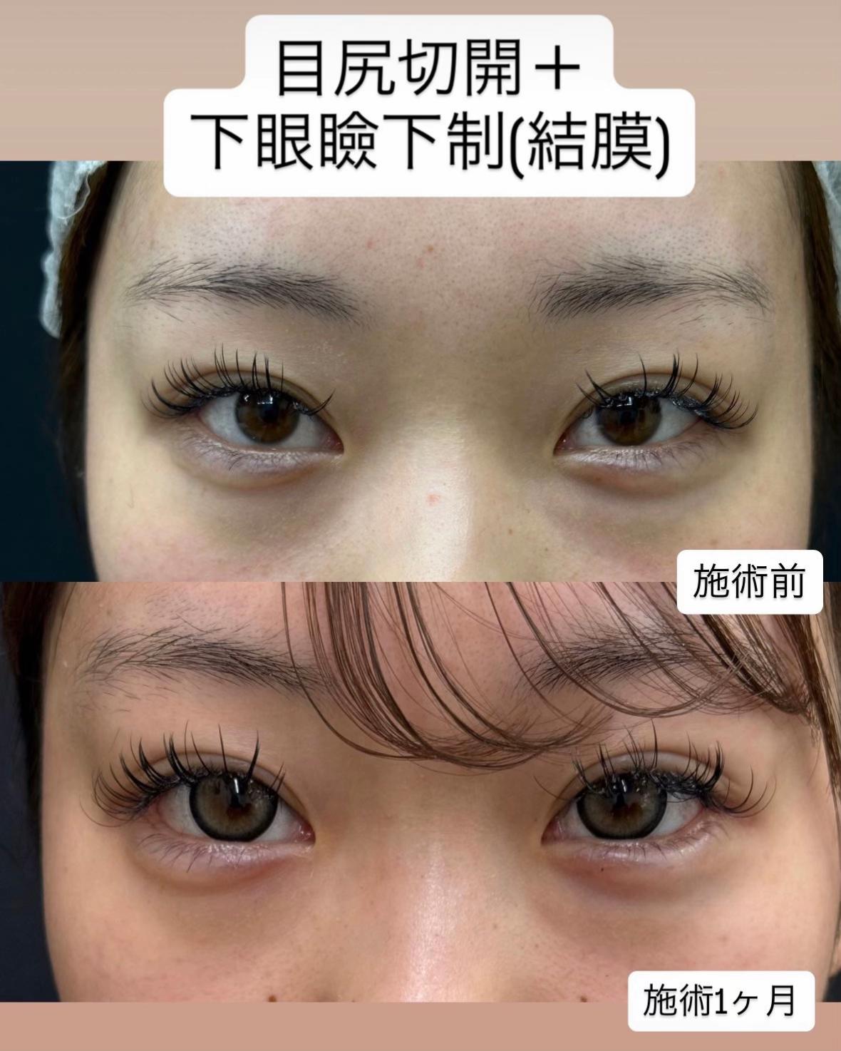 @二重整形埋没法/広島美容外科メイプルクリニック院長 吉本如良