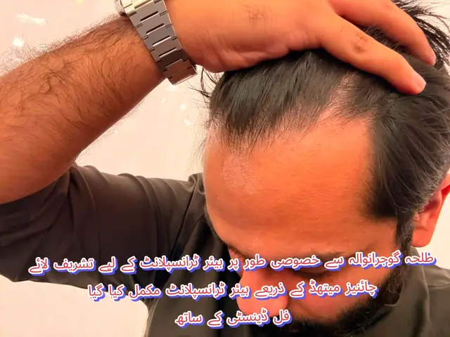 @Dr Asad shalman HairTransplant