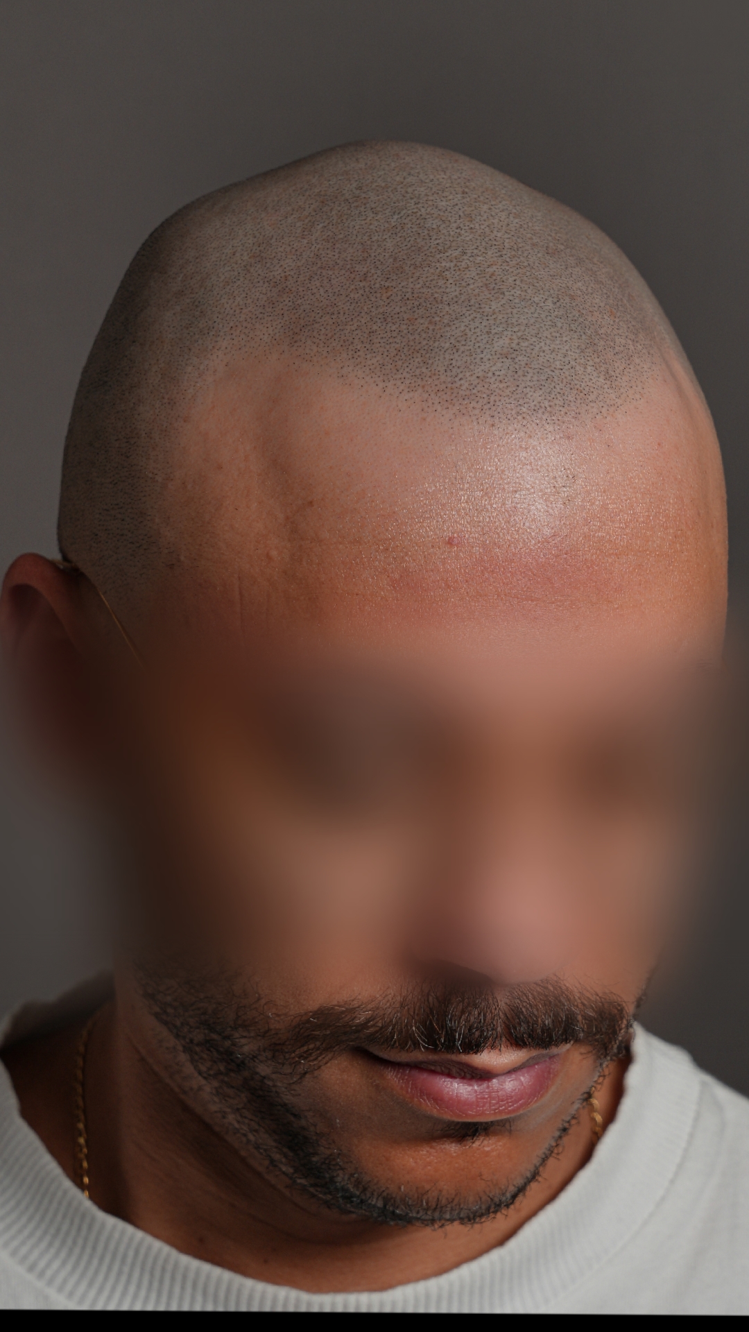 @Enhanced Scalp