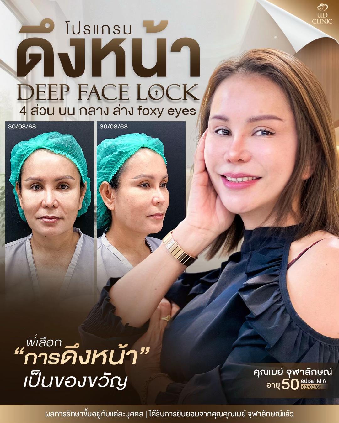 @ดึงหน้า ud clinic