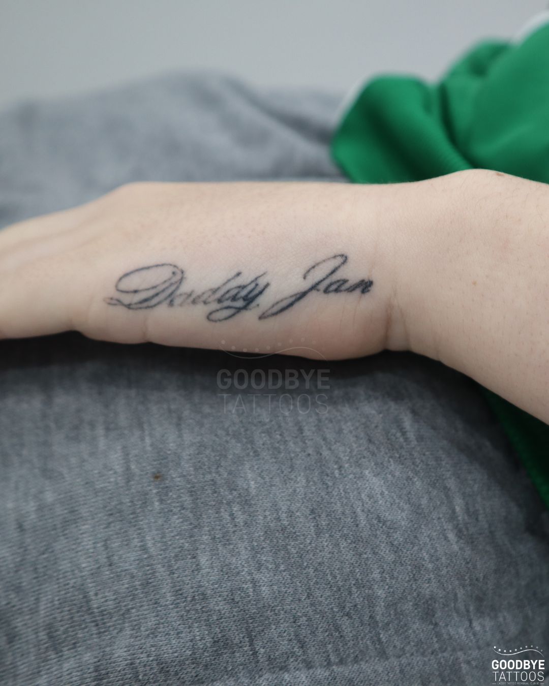 @Jamie T| Tattoo Removal Expert