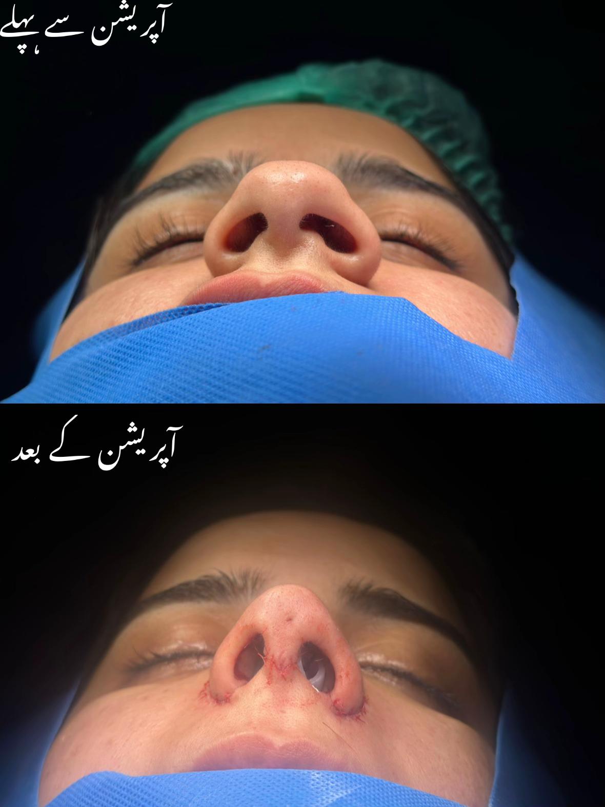 @Rhinoplastyhub clinic222
