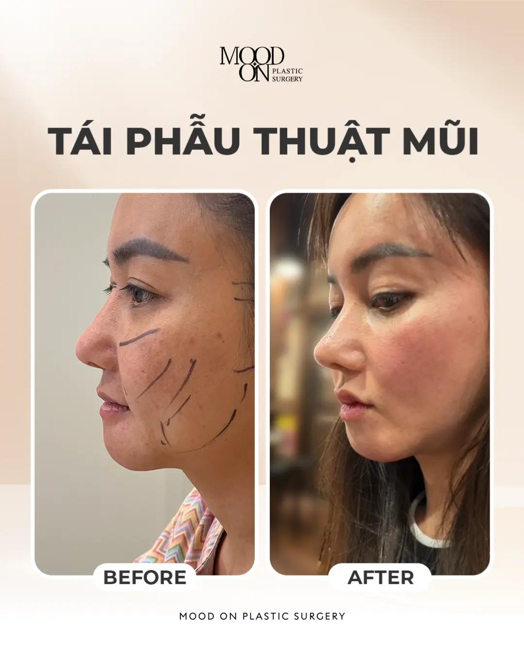 @Bệnh viện thẩm mỹ Mood On