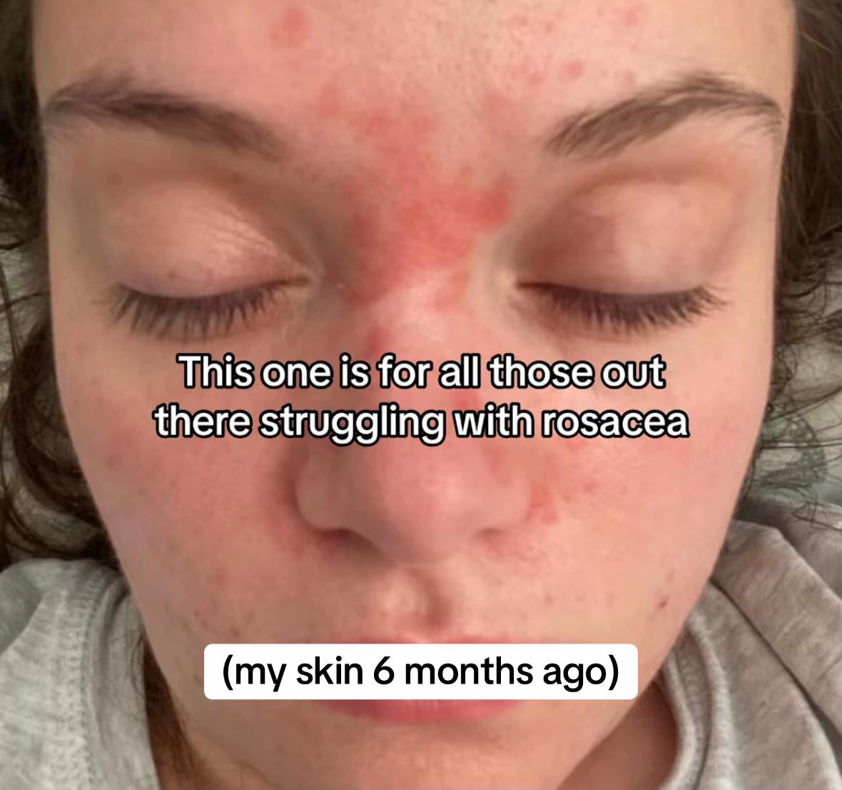 @Eczema Diaries USA & UK