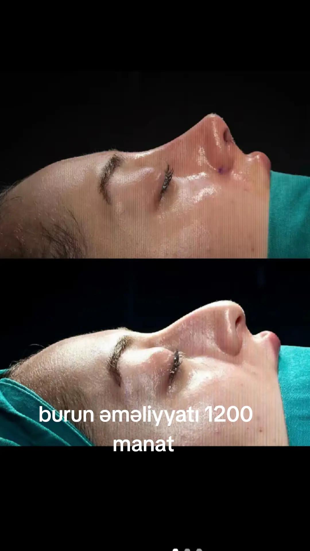 @rinoplastika_lor.dr.resad