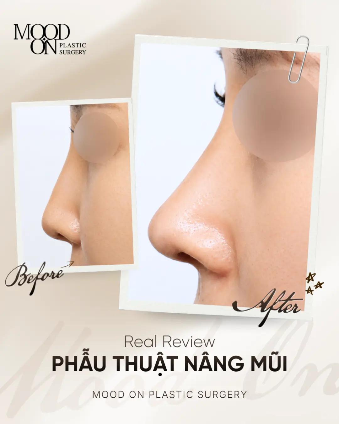 @Bệnh viện thẩm mỹ Mood On