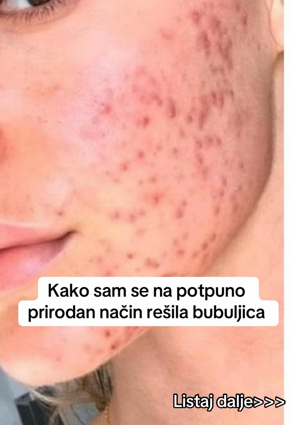@obrisii.flekice