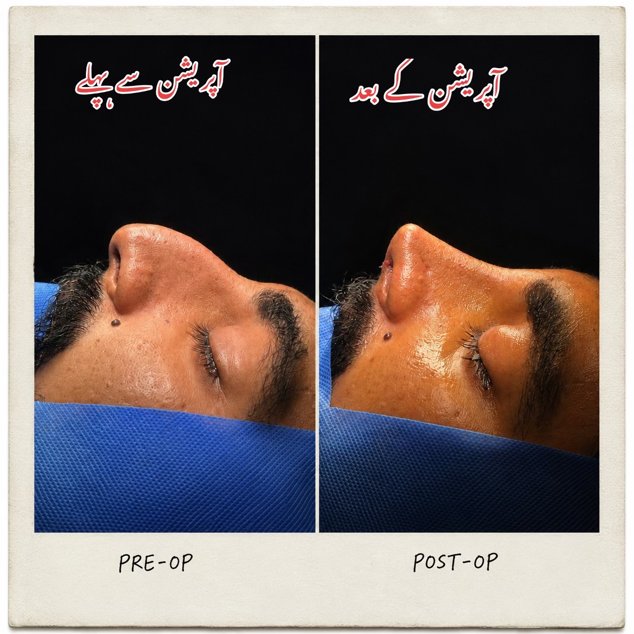 @Rhinoplastyhub clinic222